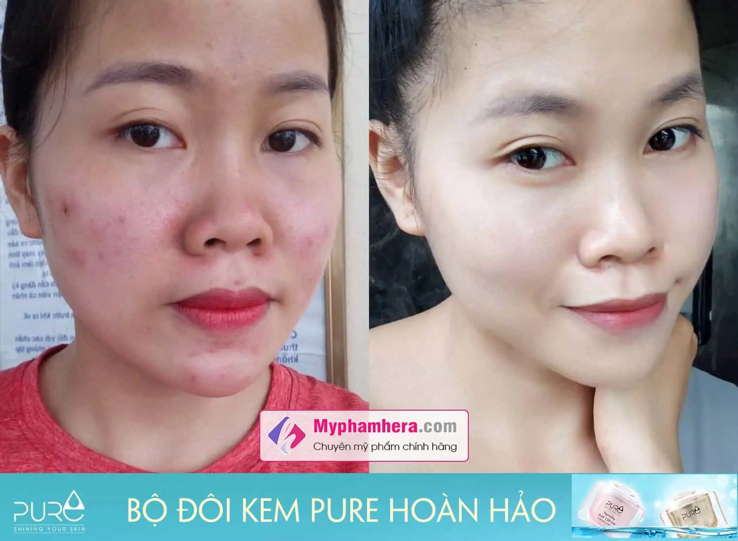 review bộ đôi kem pure korea myphamhera.com