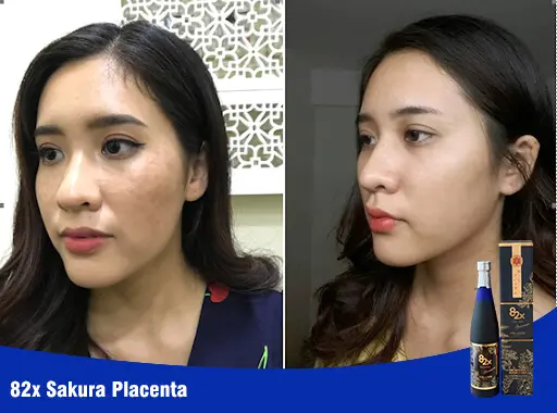 hiệu quả nước uống collagen sakura placenta mỹ phẩm hera