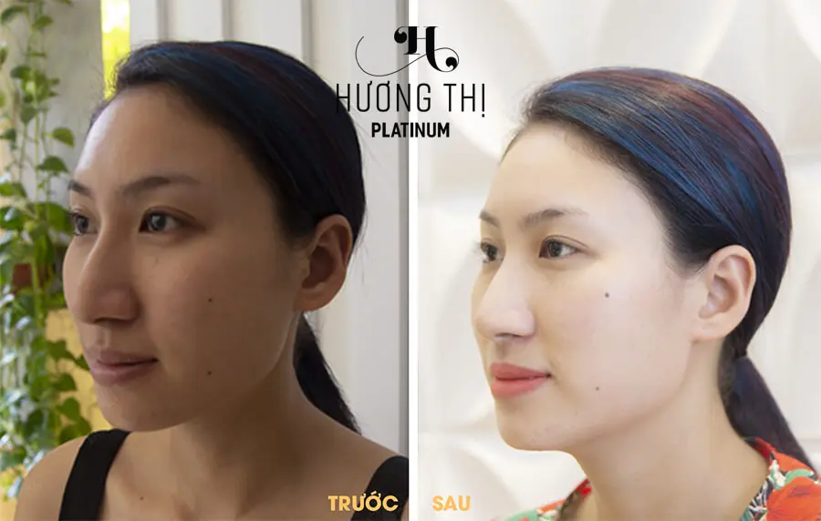 trước sau sử dụng bộ kem dưỡng trắng da đa chức năng hương thị myphamhera.com