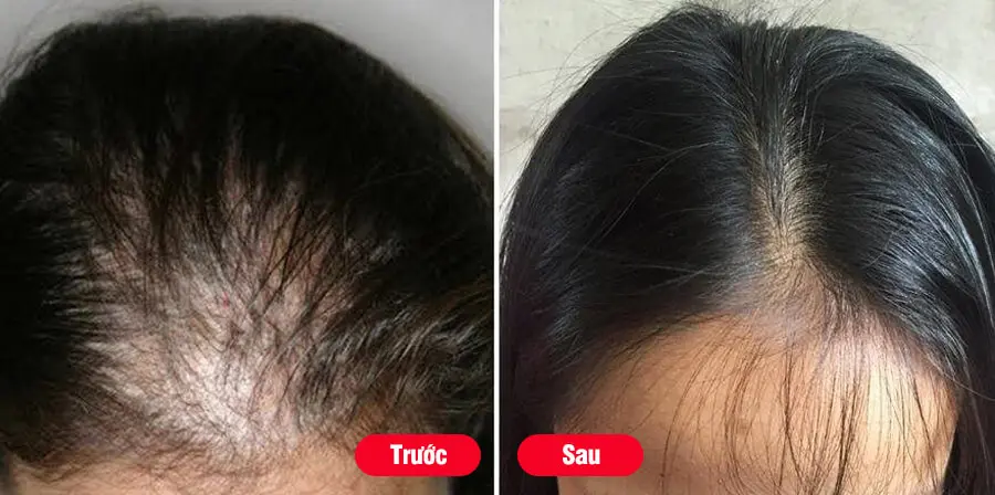 trước sau sử dụng bộ dầu gội xả serum gừng hà thủ ô weilaiya myphamhera.com