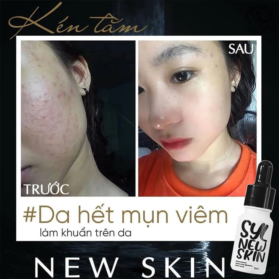 serum trị mụn kén tằm newskin có tốt không myphamhera.com