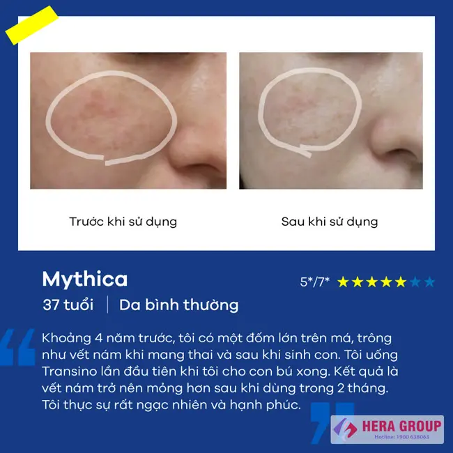 Review Viên uống trị nám Transino II Nhật Bản