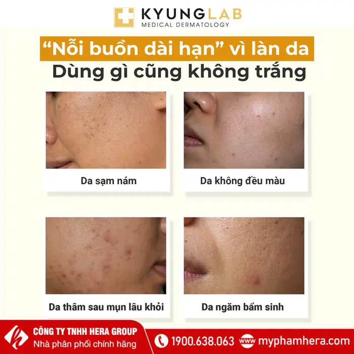 Đối tượng sử dụng Serum nám TRX KyungLab Pigment Control Hàn Quốc