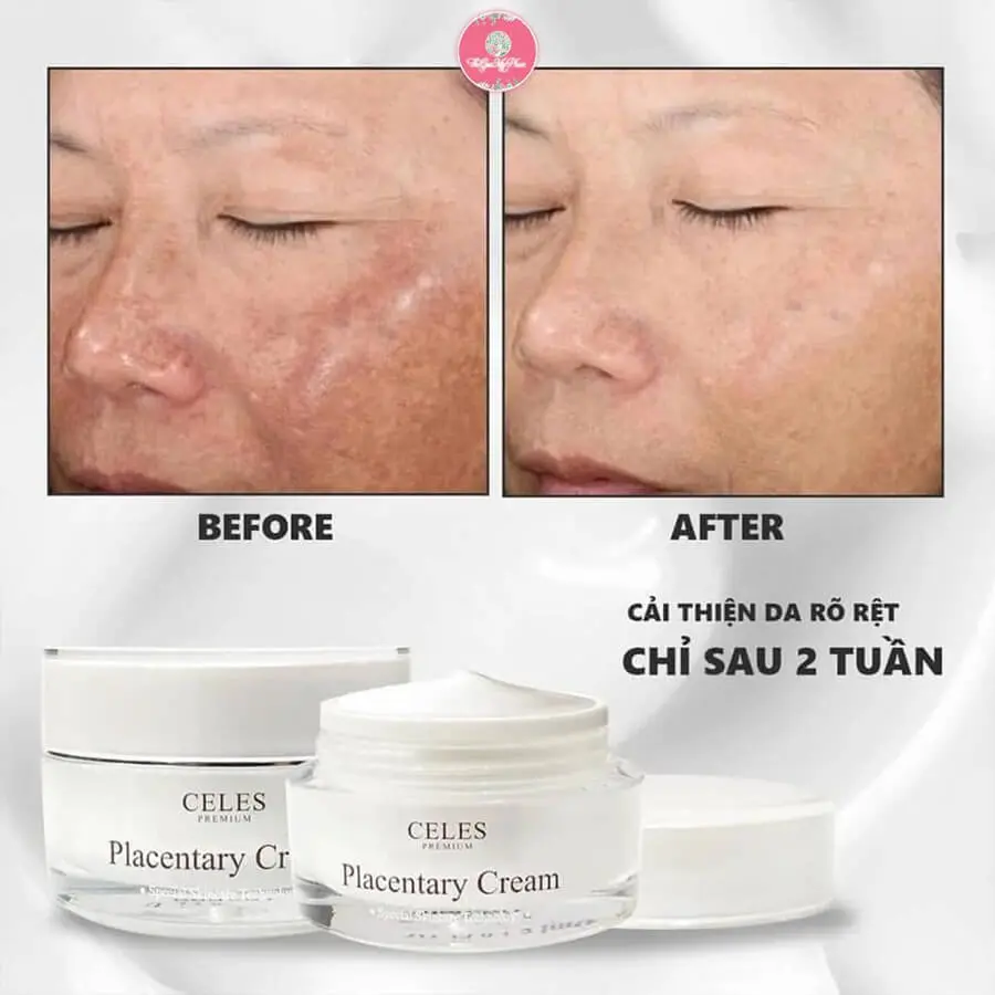 Kem nhau thai cừu Celes Placentary Cream có tốt không