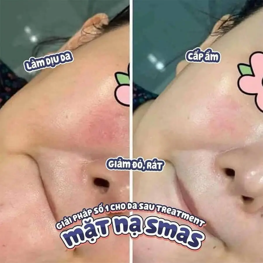 Mặt nạ dưỡng da SMAS Peptide Silk có tốt không