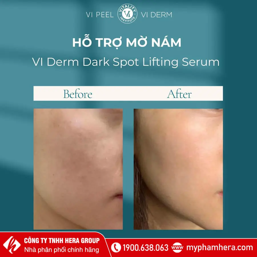 Tinh chất dưỡng trắng làm mờ thâm nám VI Derm Dark Spot Lifting Serum