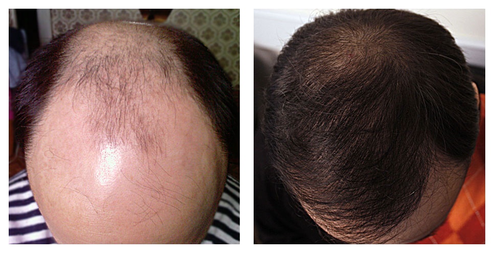 kết quả bộ sản phẩm chuyên trị ngăn ngừa rụng tóc amla